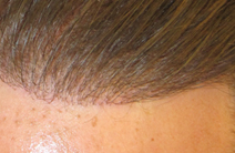 Exoderm Hair Implant