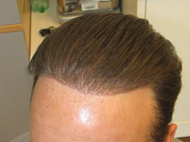 Exoderm hair implant