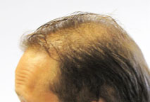  hair implant - Exoderm